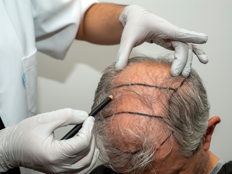 como é feito o transplante capilar fue