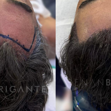 Transplante capilar sem raspar o cabelo