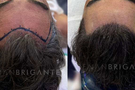 Transplante capilar sem raspar o cabelo