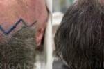 antes e depois do transplante capilar