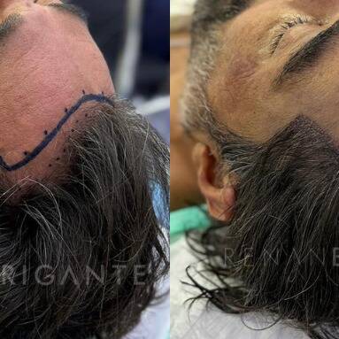 transplante capilar sem raspar o cabelo