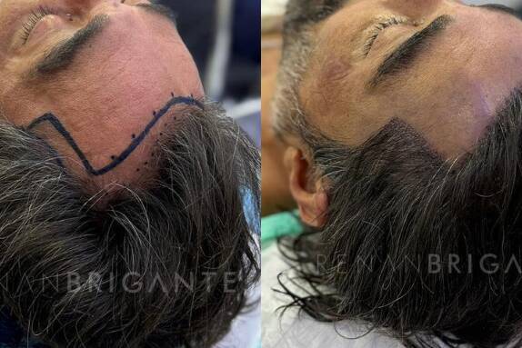 transplante capilar sem raspar o cabelo