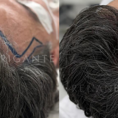 clinicas de transplante capilar sem cirurgias