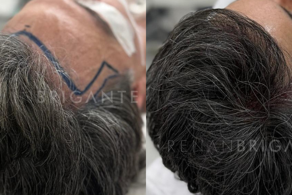 clinicas de transplante capilar sem cirurgias